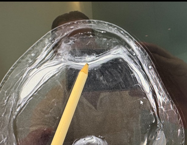 Dr. Böttenberg klärt auf: Microfracture am Knie bei schweren Knorpelschäden (CM 4°) 3 Dr. Böttenberg klärt auf: Microfracture am Knie bei schweren Knorpelschäden (CM 4°)